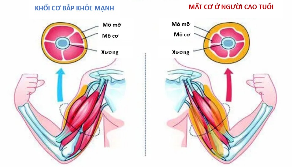 mất cơ ở người cao tuổi
